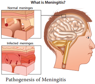 Neisseria meningitidis (Meningococcus) img 1