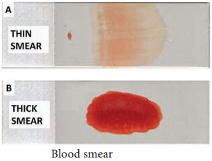 Plasmodium Falciparum and P. vivax (Sporozoa - Plasmodium) img 3