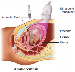 Detection Of Foetal Disorders During Early Pregnancy img 1