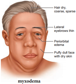 Hypo and Hyper Activity of Endocrine Glands and Related Disorders img 5