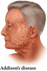 Hypo and Hyper Activity of Endocrine Glands and Related Disorders img 8